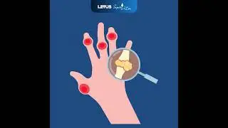 Understanding the Stages and Dangers of Gout