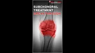 Global Arthritis? How Subchondral IO Stem Cells Treat the Entire Knee