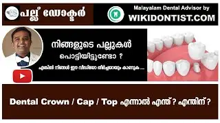 Dental Crown / Cap / Top എന്നാൽ എന്ത്? എന്തിന്? /Malayalam Dental Videos/മലയാളം/Dr.Thomas nechupadam