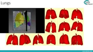AI-based Segmentation in CT - Webinar by RSIP Vision July 24