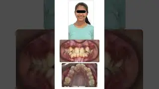 Why BaTR Braces Are Better than Robotic Braces | Custom Torque Made Simple