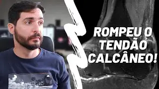 Rompeu o tendão de Aquiles! E agora? Será que precisa operar? | Galvani Filho