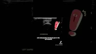 Ultrasound Guided Interventions: Cases (Supraspinatus Tendon Tear) #ultrasound