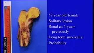 Surgery for bone metastases