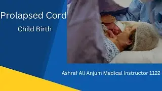 prolapsed cord#
