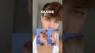 how to fix recessed chin #looksmaxing #chin #jawline
