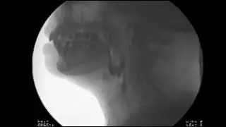 Modified Barium Swallow Study - Michael Groher | MedBridge