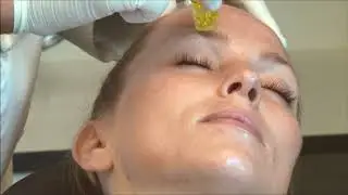Aquagold fine touch vs powered micro needling technique