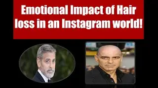 Emotional Impact of Hair loss in an Instagram world!