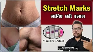 Many ways to remove stretch marks || Stretch Marks Treatment | Stretch Marks Removal | Dr. Nitish