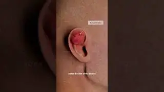 What is an auricular abscess and how can it affect your ear health? Explained in 3D