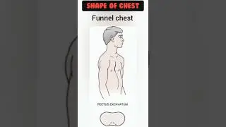Abnormal shape of chest | Respiratory system | chest | Pectus carinatum | Barrel | Pectus excavatum