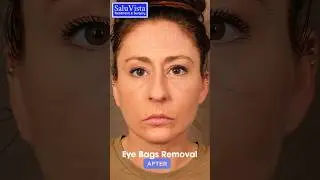 This is how we do #eyelids or #eyebags removal surgery. #eyebagsurgery #bestplasticsurgeon #turkey
