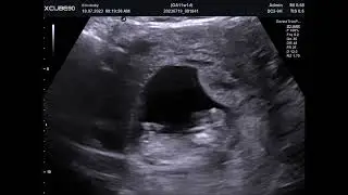 Baby Echo 11 Weken Zwanger Foto's en Filmpjes