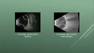 Ocular Ultrasound part 2 | Dr. Mahmoud Sedky