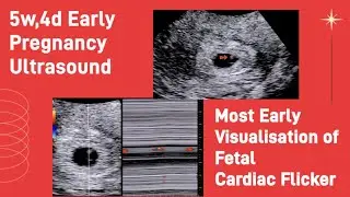 Most early Fetal Cardiac Flicker Visualization - 5.5wks | Ultrasound