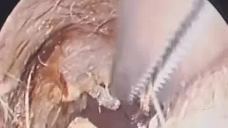 Healthy ear care routine,easy ear cleaning advice,ear cleaning safety tips,Dr sudhir sultan