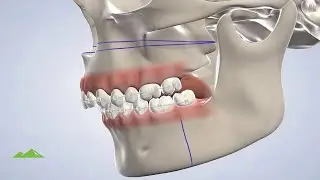 Orthognathic Surgery at Utah Surgical Arts