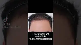 Penanaman Rambut Dikorea ? #oplas #tanamrambut #hairtransplant #hairlinetransplant #oplas