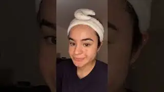 burning acne off 🔥