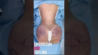 Define your beauty with Safe BBL and Liposuction transformations that inspire #beforeandafter