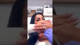 👄#skinin #lipfiller #aestheticclinic #NaturalResults #Injectables #NonSurgical #viral #fyp