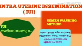 INTRA UTERINE INSEMINATION, IUI, SPERM WASHING METHOD