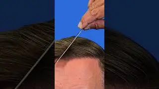 FUE Hair Transplant | Before And After | 4037 Grafts | Hasson And Wong