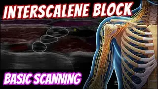 Interscalene block - BASIC scanning