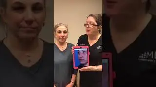 Restylane Defyne 1 Week Post Treatment