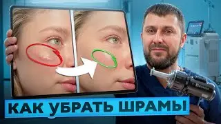 Лазерная шлифовка: как убрать рубцы и ускорить реабилитацию