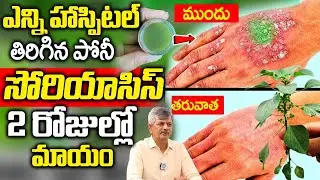 Psoriasis Causes and Symptoms in Telugu |Skin Disease Solution in Ayurveda |సోరియాసిస్2రోజుల్లో మాయం