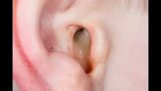 Kaan Ka Infection Peep Ka Ana کان کا انفیکشن پیپ کا آنا  by Professor Dr  Imran Saeed