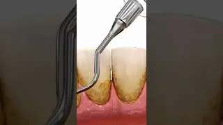 Teeth cleaning || ORAL PROPHYLAXIS #oral health #scaling #smile