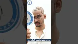 Best Hair Transplant in Pune | Big FUE Grade 4 | 3240 Grafts | Cost of Hair Transplant in Pune