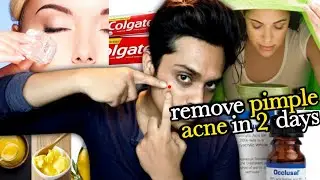 How to Remove PIMPLE & ACNE NATURALLY FAST | Grooming Tips For Men For Clear Skin & Acne treatment