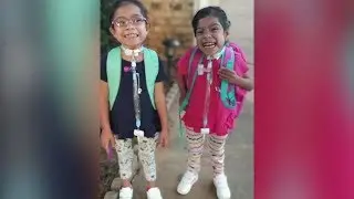 Doctor Who Helped Separate Conjoined Twins Performs Follow-up Surgeries on One of the Girls
