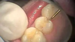 WATERLASE MD: Slot Prep    95128