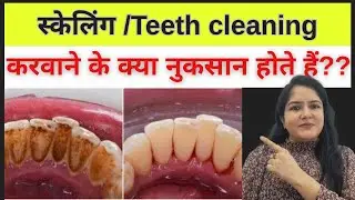 Dental scaling side effects. Teeth cleaning by doctor. Dental cleaning. #dental #dentalplaque 