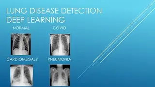 Lung Disease Detection (Deep Learning Project)