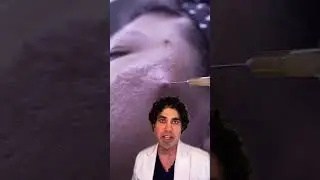 Cow Collagen To Improve Skin Quality? 🤩 (Filler For Acne Scars) #acnescars  #dermalfillers
