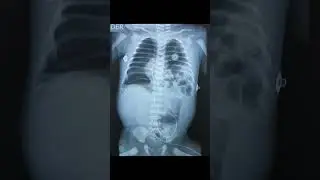 HERNIA DIAFRAGMATICA #imagenologia #medicina #radiologia #viral #torax #trending #radiografia