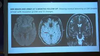 AIOC2022 FP741 PPP   Neuro Ophthalmology topic Sudden vision loss due to Isolated Bilateral Lateral