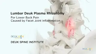 Lumbar Deuk Plasma Rhizotomy (DPR) for Facetogenic Back Pain - (3D Animation)