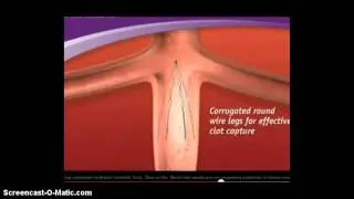 IVC Filter