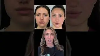 Преображение жевательных мышц с помощью ботокса