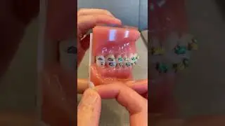 How to Use OrthoDots if Ortho Wax keeps falling off | Dr Bar The Braces Doc