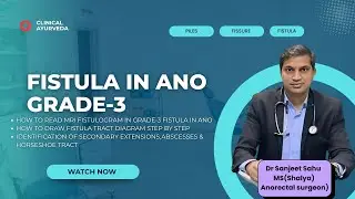 Fistula in Ano Grade 3MRI Fistulogram Reading, Diagram & Treatment Plan | Part 11 | Dr. Sanjeet Sahu