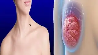 Swollen Supraclavicular Lymph Nodes: Causes And Treatment