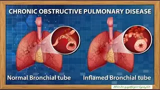 Students Guide to COPD | Pathophysiology, Symptoms & Treatment (Step by step for the students).